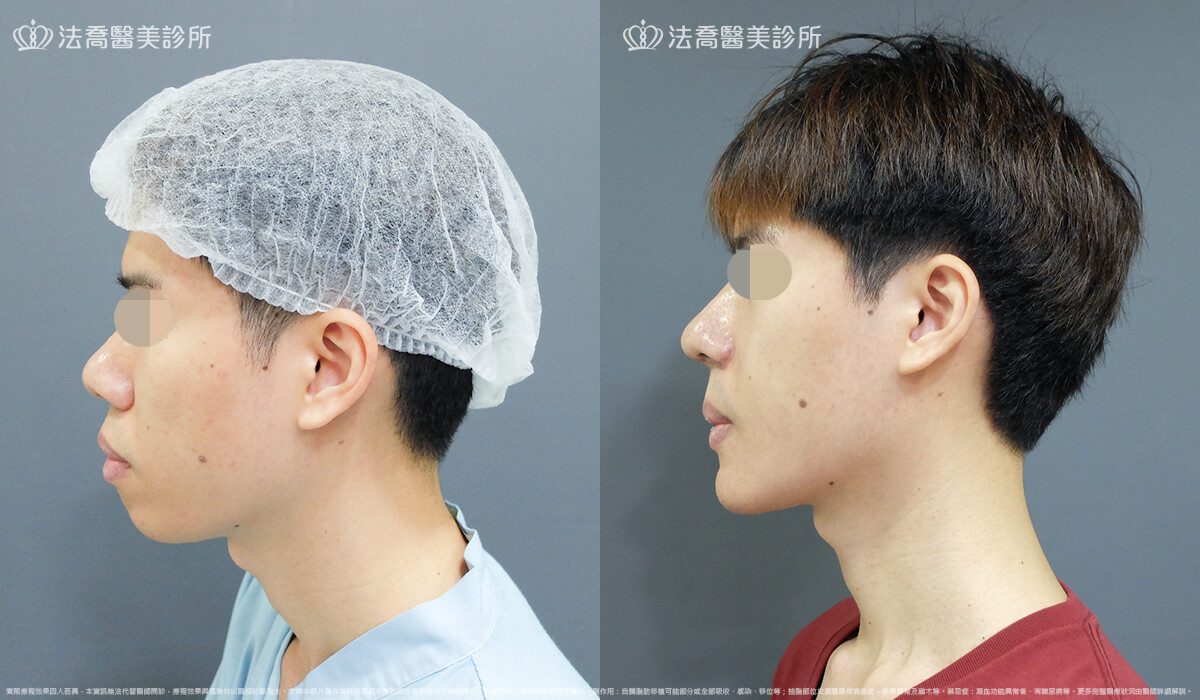 法喬醫美診所,邱浚彥,自體肋骨隆鼻