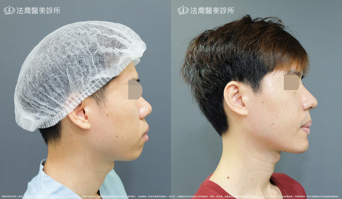 法喬醫美診所,邱浚彥,自體肋骨隆鼻