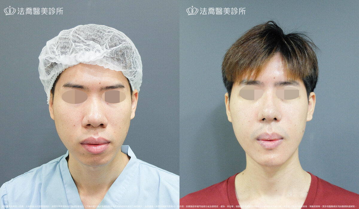法喬醫美診所,邱浚彥,自體肋骨隆鼻