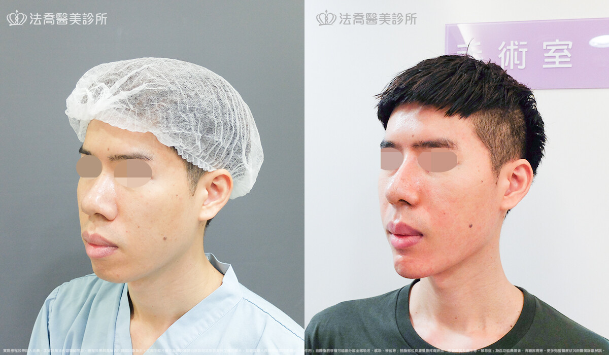 法喬醫美診所,邱浚彥,自體肋骨隆鼻
