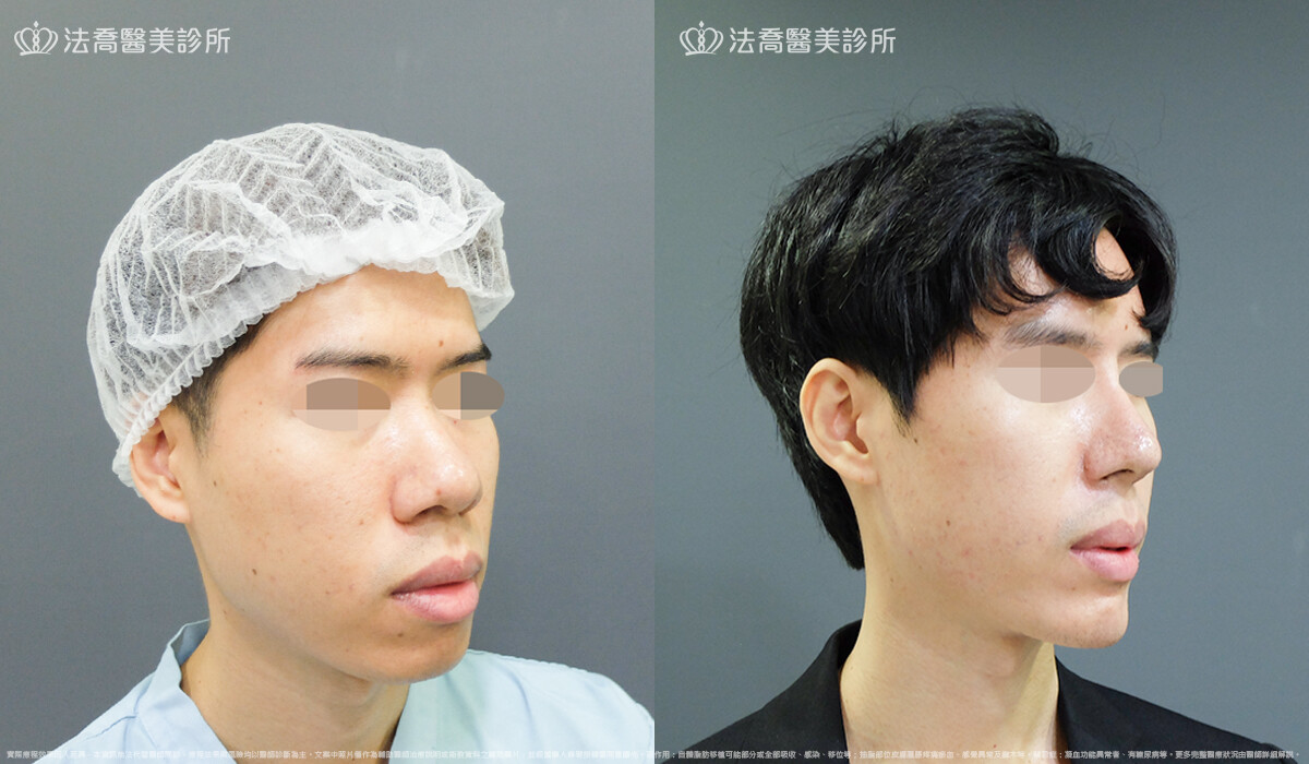 法喬醫美診所,邱浚彥,自體肋骨隆鼻