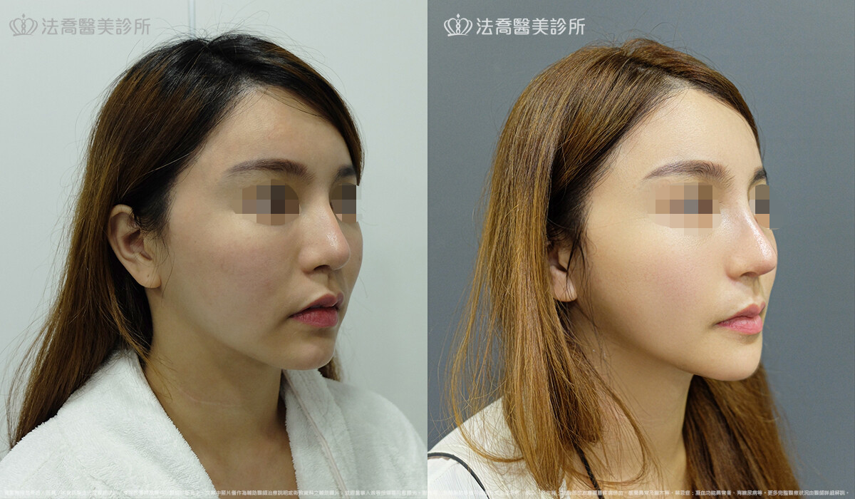 卡麥拉取出 / 自體肋骨隆鼻 / 人工骨墊下巴