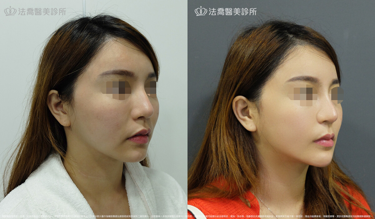 卡麥拉取出 / 自體肋骨隆鼻 / 人工骨墊下巴