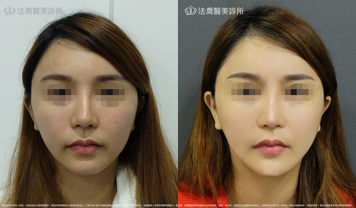 卡麥拉取出 / 自體肋骨隆鼻 / 人工骨墊下巴