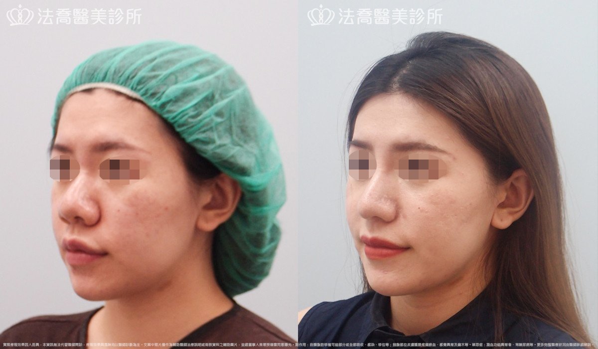 goretex隆鼻,法喬醫美診所,邱浚彥