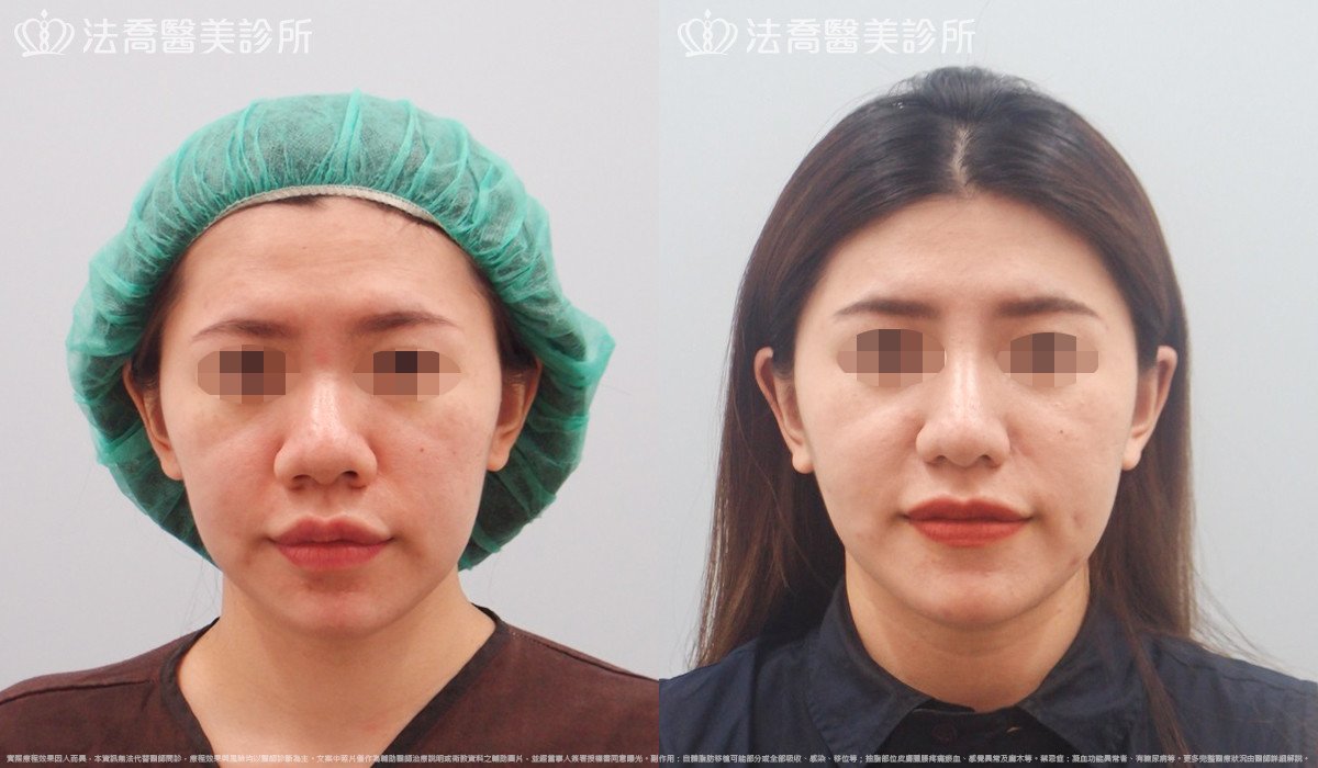 goretex隆鼻,法喬醫美診所,邱浚彥