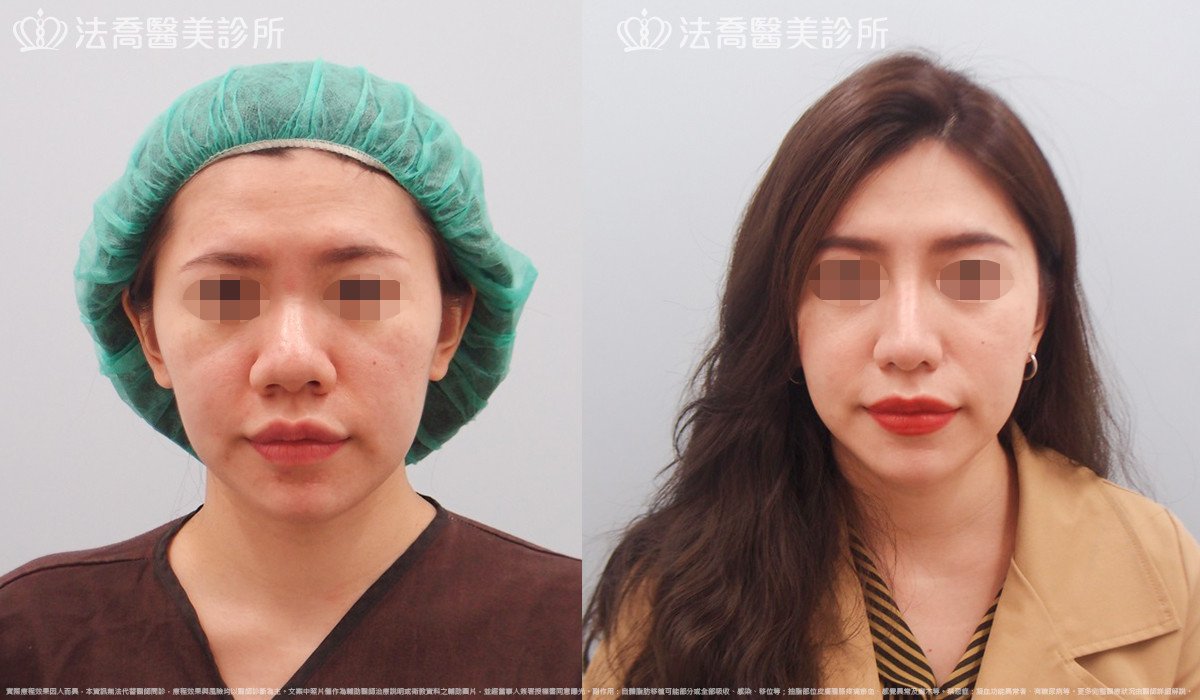 goretex隆鼻,法喬醫美診所,邱浚彥