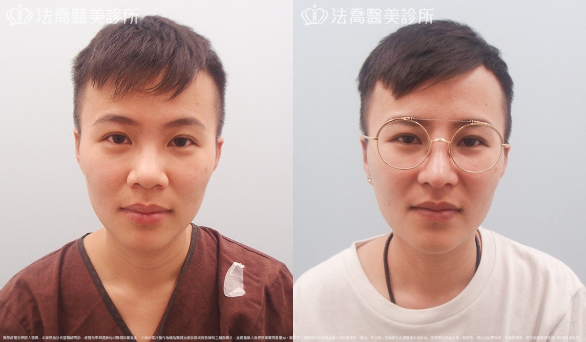 goretex隆鼻,法喬醫美診所,邱浚彥