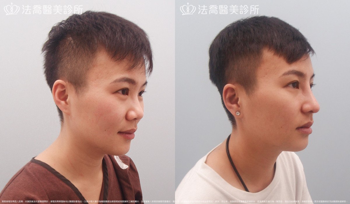 goretex隆鼻,法喬醫美診所,邱浚彥