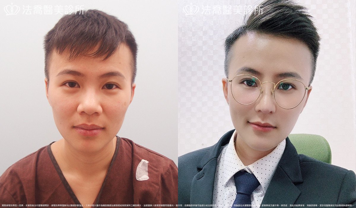 goretex隆鼻,法喬醫美診所,邱浚彥