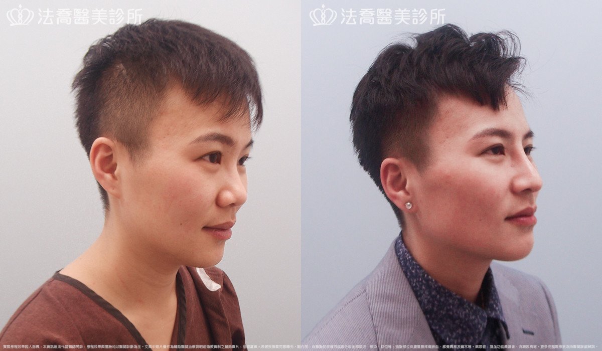 goretex隆鼻,法喬醫美診所,邱浚彥