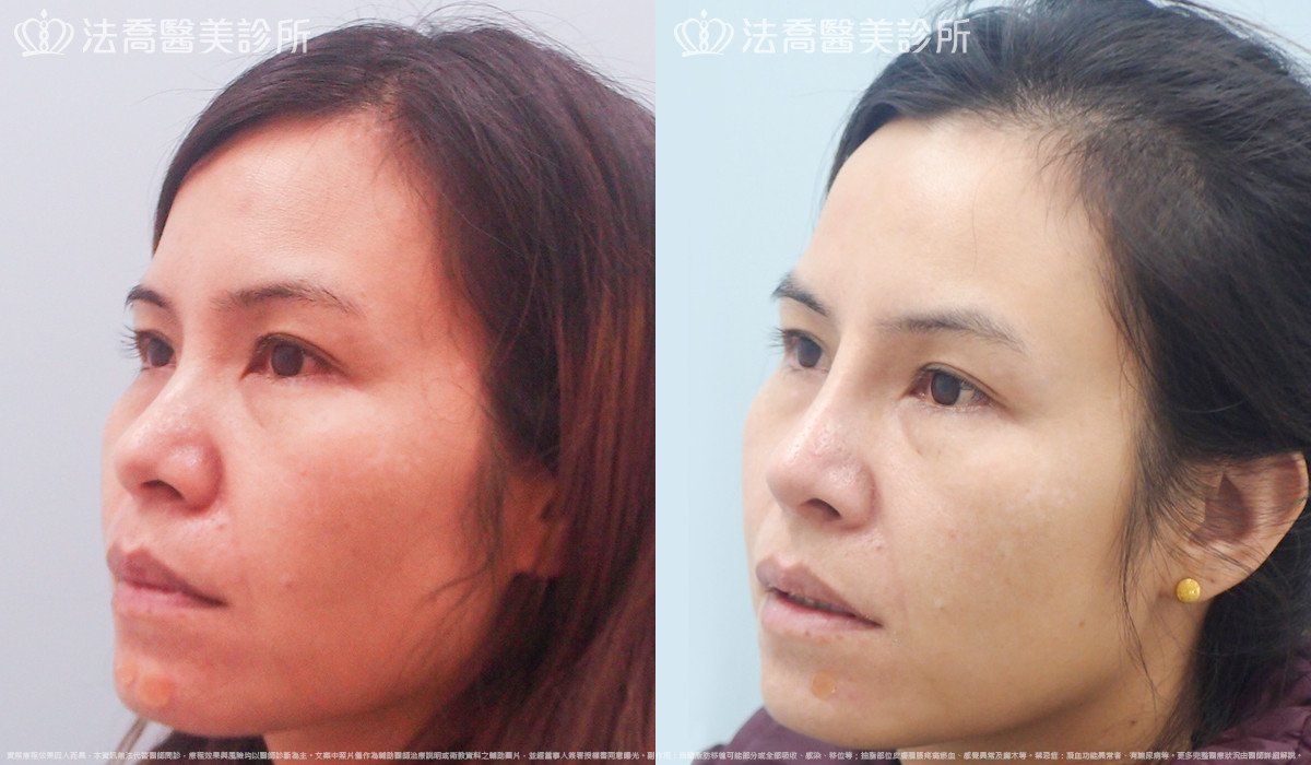 goretex隆鼻,法喬醫美診所,邱浚彥