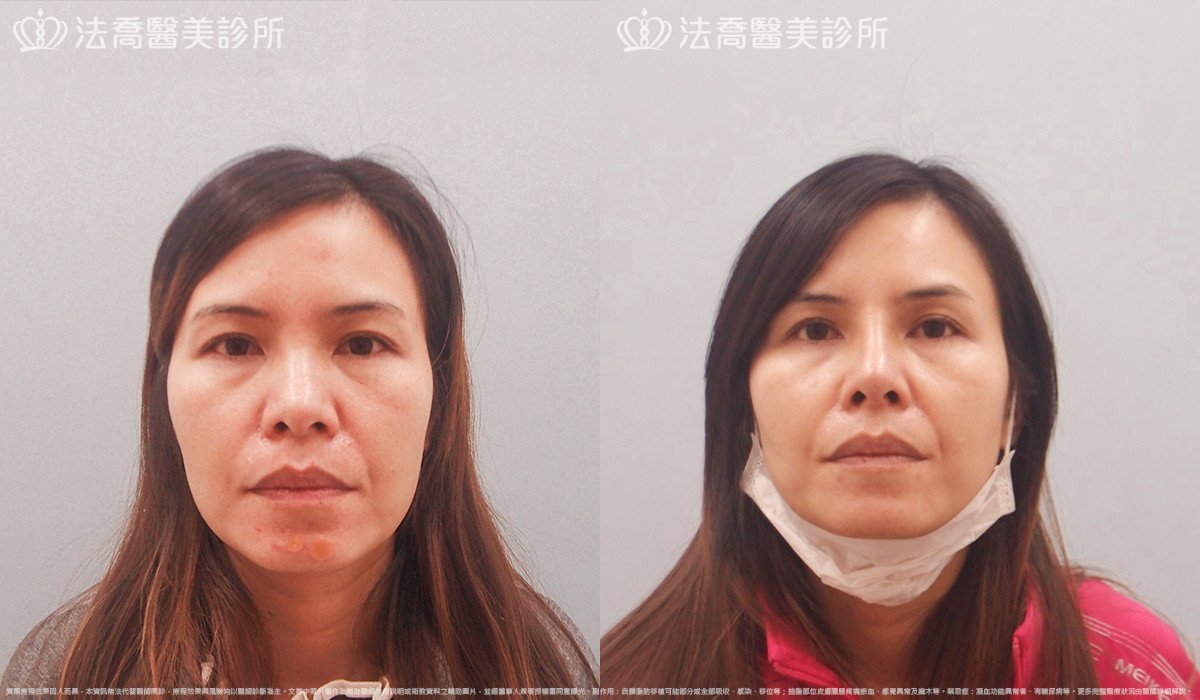 goretex隆鼻,法喬醫美診所,邱浚彥