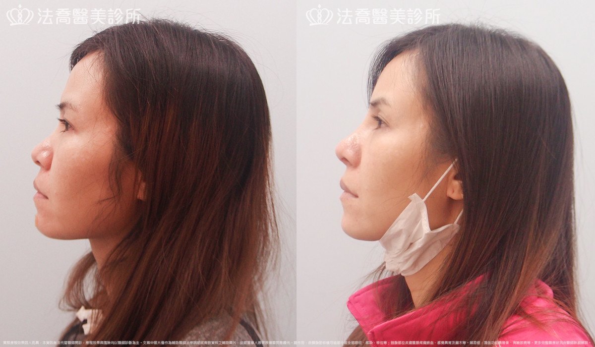 goretex隆鼻,法喬醫美診所,邱浚彥