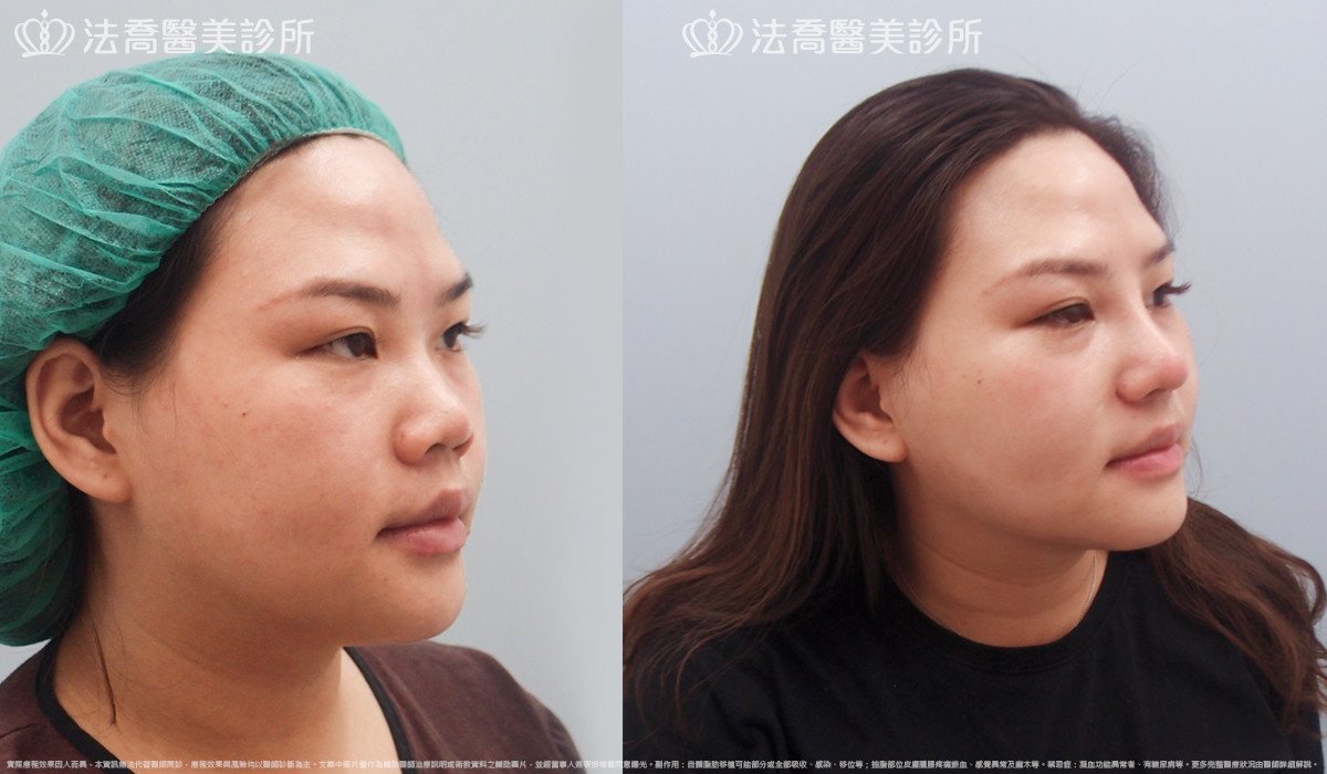 goretex隆鼻,法喬醫美診所,邱浚彥