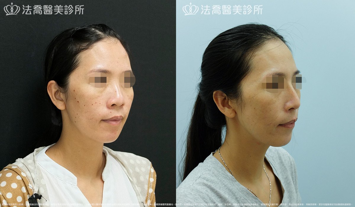 法喬醫美診所,邱浚彥,Goretex隆鼻 