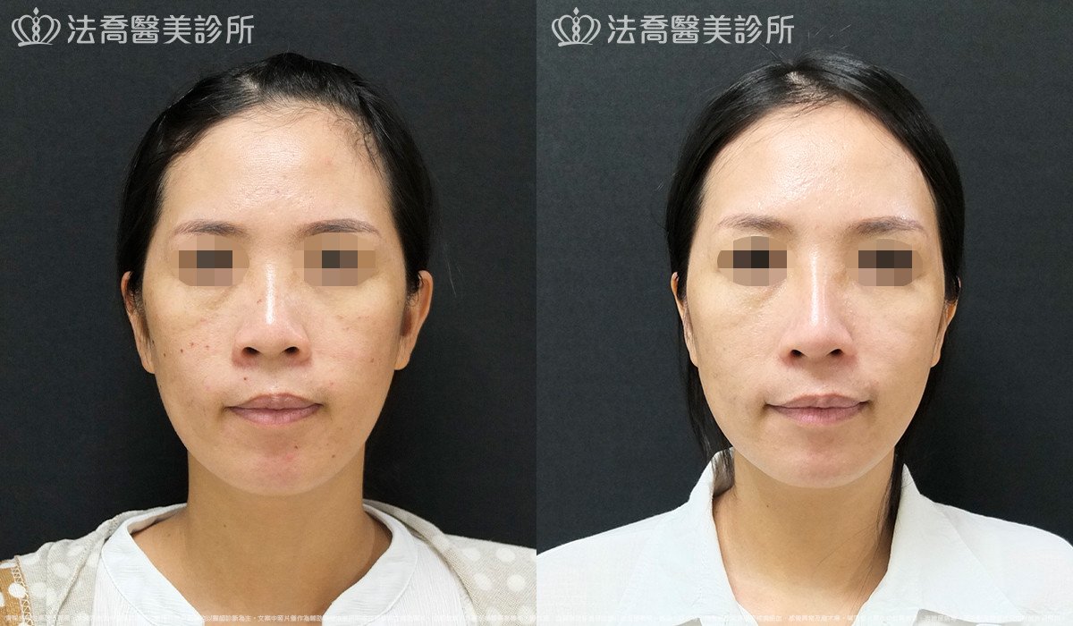 法喬醫美診所,邱浚彥,Goretex隆鼻 