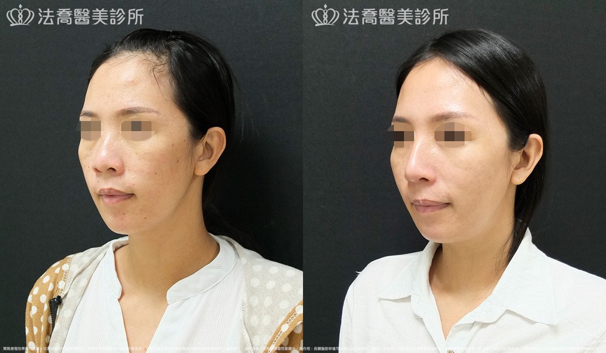 法喬醫美診所,邱浚彥,Goretex隆鼻 