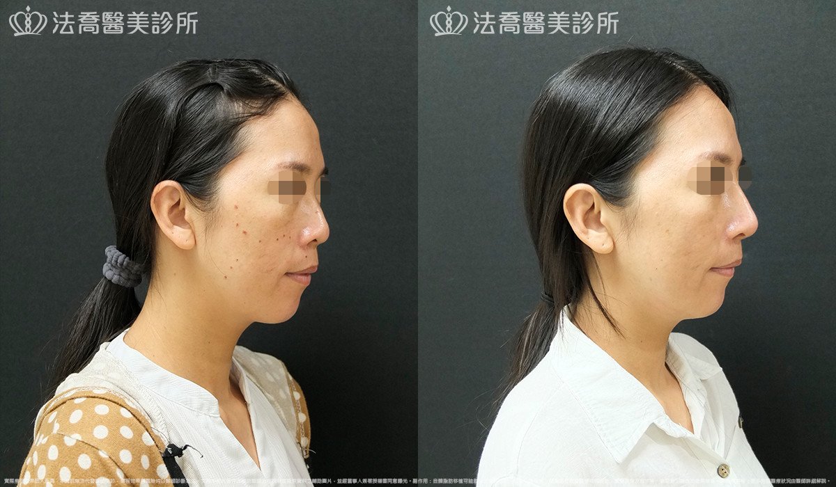 法喬醫美診所,邱浚彥,Goretex隆鼻 