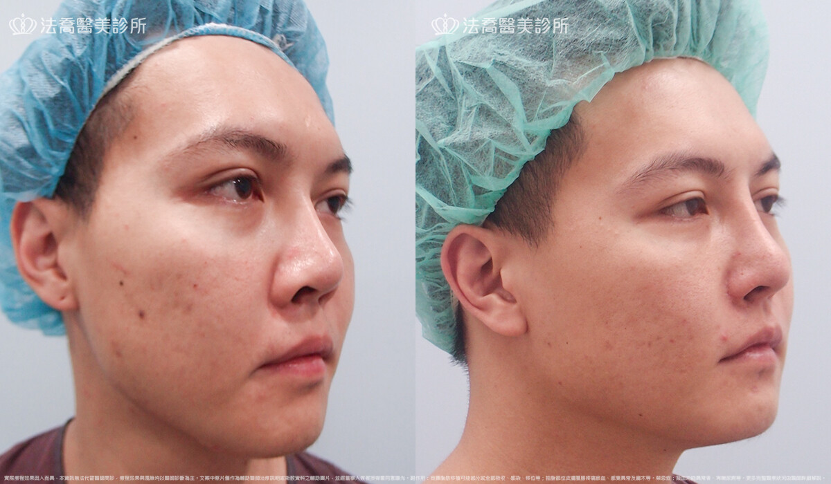 goretex隆鼻,法喬醫美診所,邱浚彥