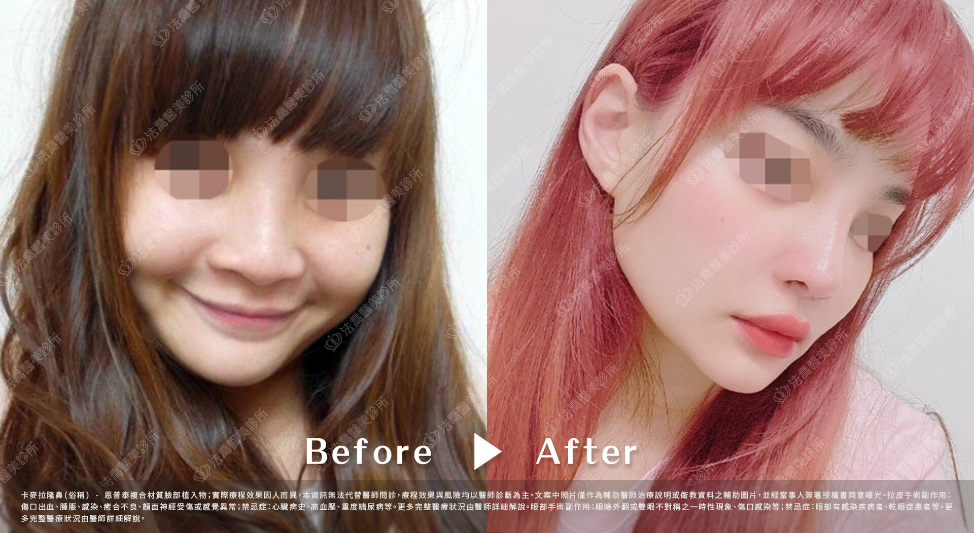 法喬醫美診所,邱浚彥,隆鼻