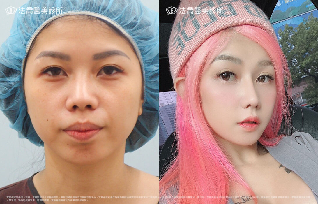 goretex隆鼻,法喬醫美診所,邱浚彥