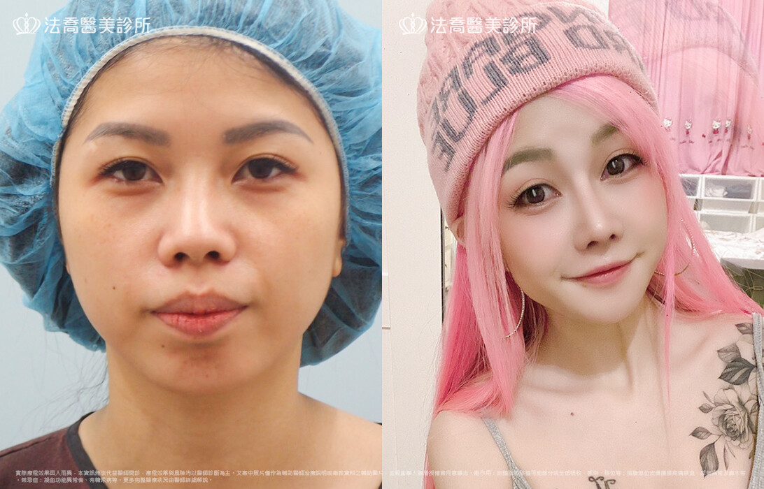 goretex隆鼻,法喬醫美診所,邱浚彥