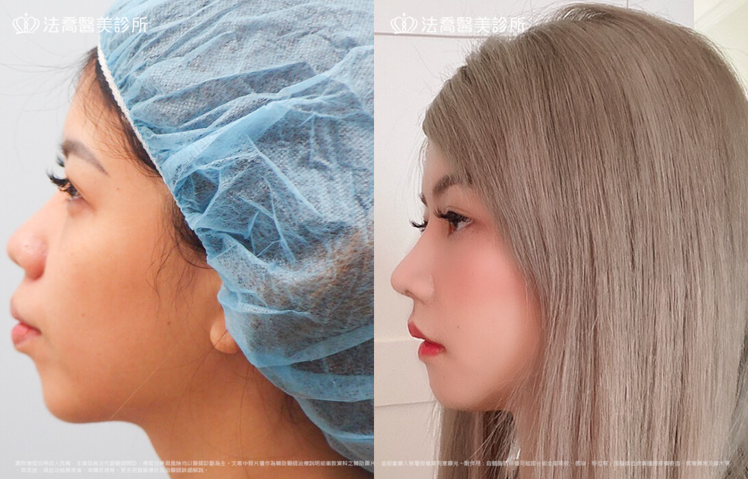 goretex隆鼻,法喬醫美診所,邱浚彥