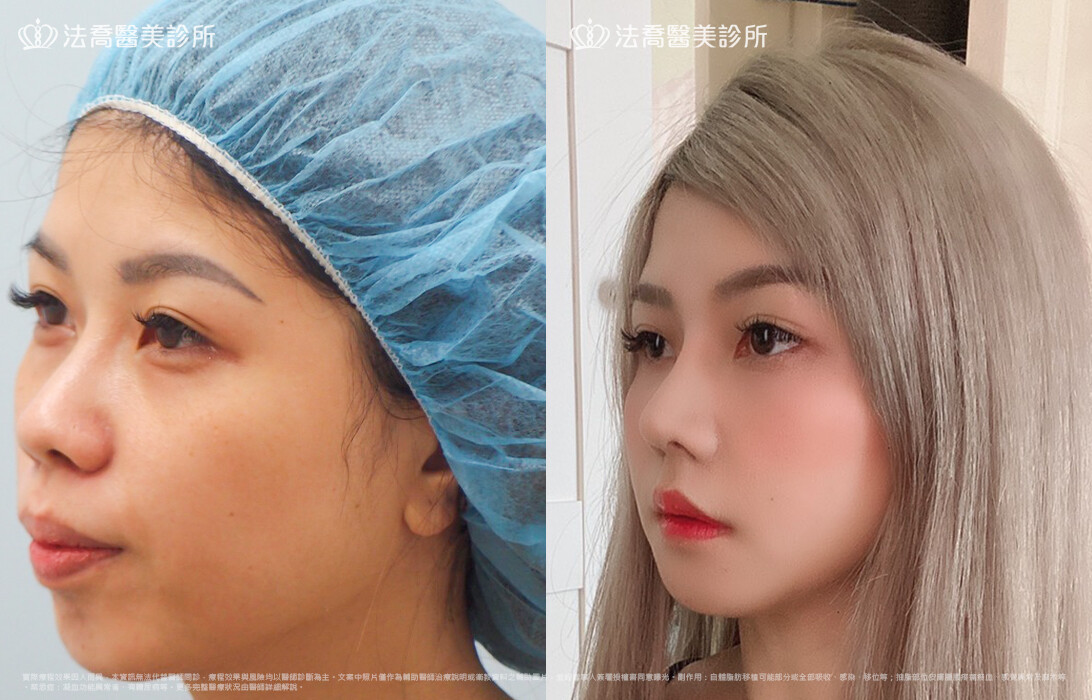 goretex隆鼻,法喬醫美診所,邱浚彥