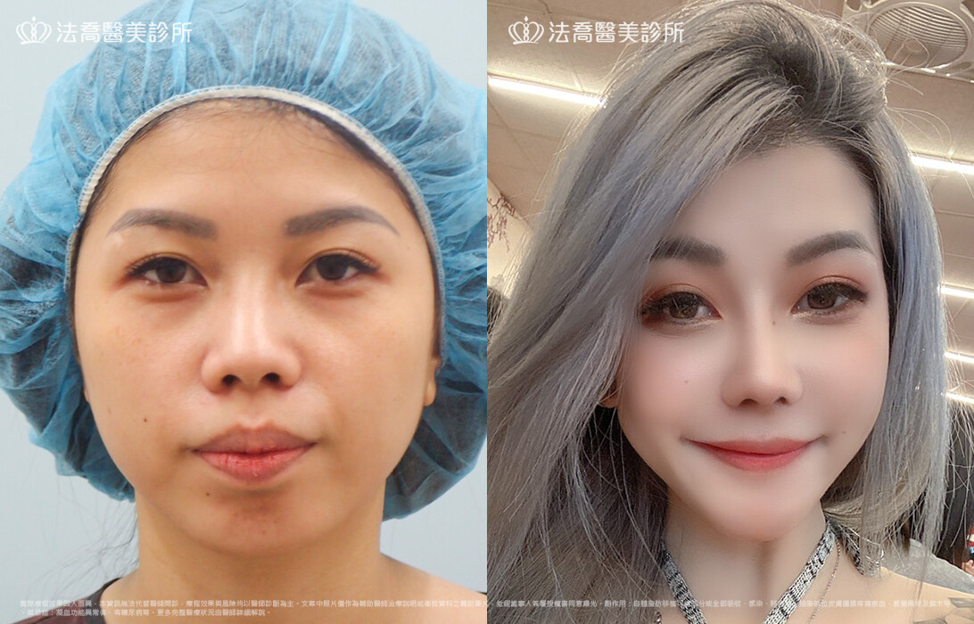 goretex隆鼻,法喬醫美診所,邱浚彥