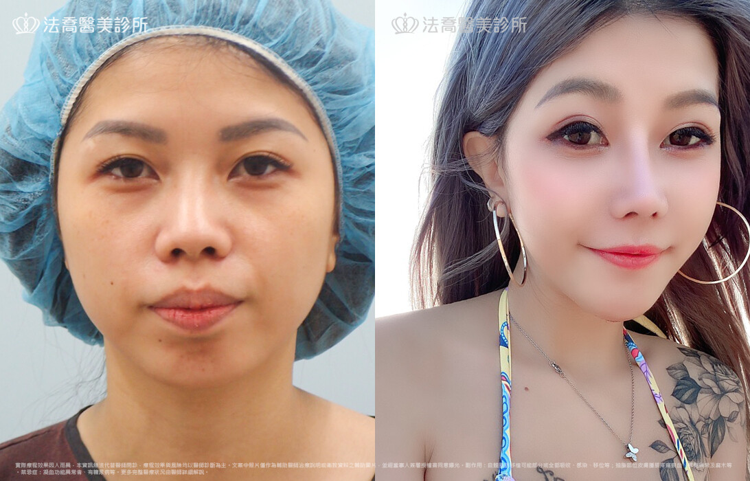 goretex隆鼻,法喬醫美診所,邱浚彥
