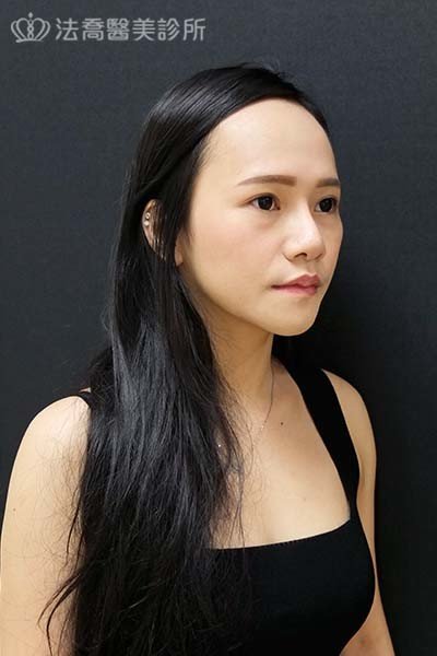 自體肋骨隆鼻