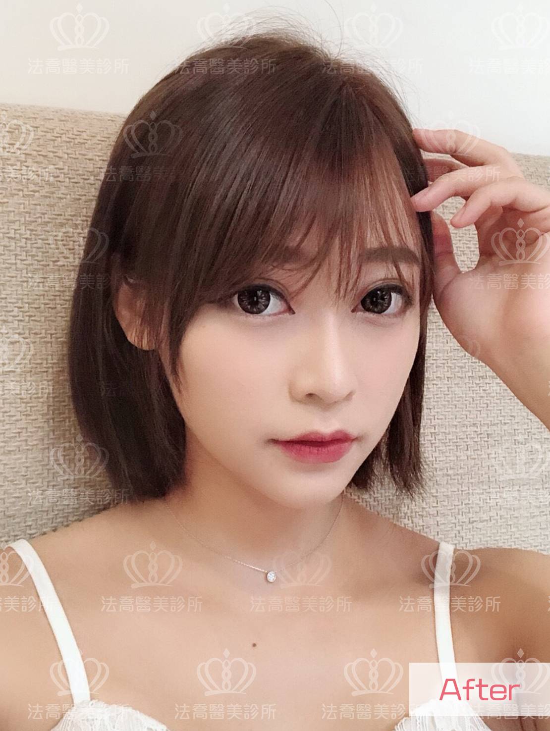 法喬醫美-Goretex隆鼻案例