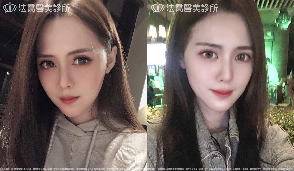 法喬醫美診所,邱浚彥,墊下巴