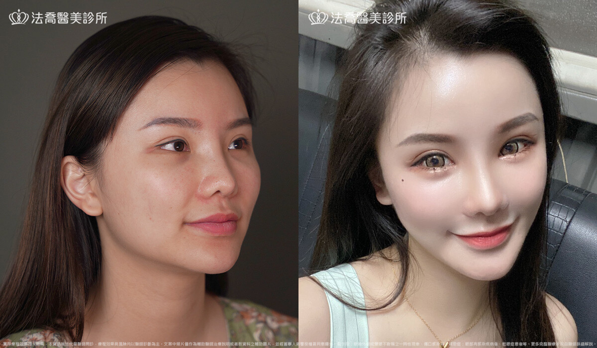 隆鼻推薦
