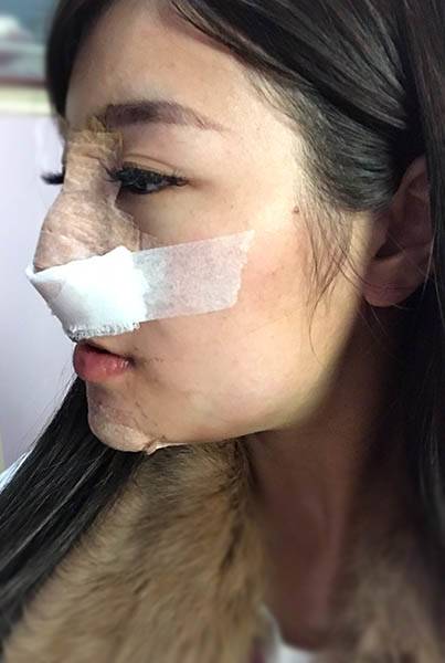法喬醫美診所_骨水泥墊下巴術後第一天