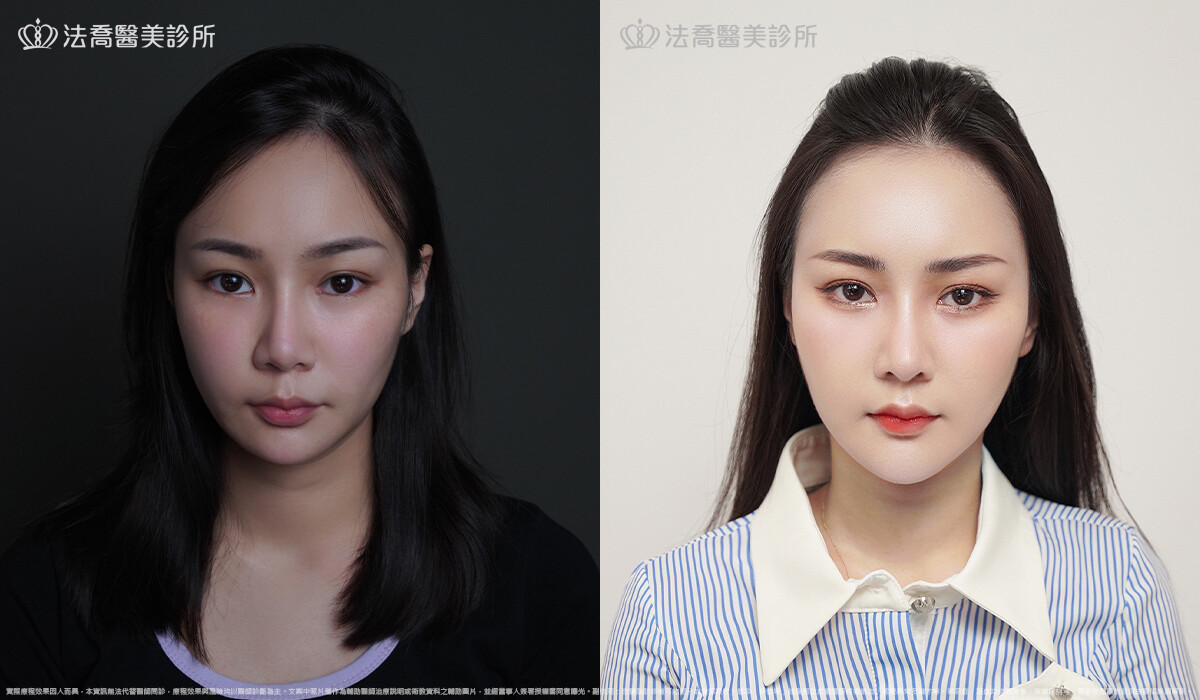 人工骨墊下巴(俗稱)