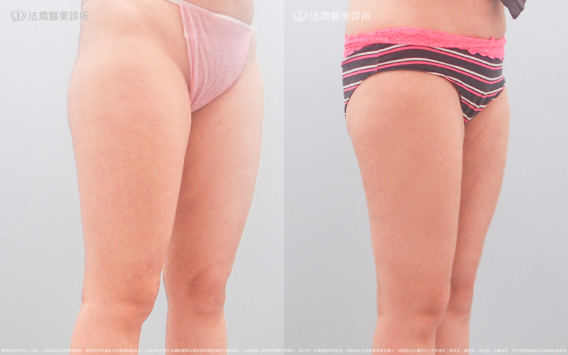法喬醫美診所,邱浚彥,威塑大腿環抽