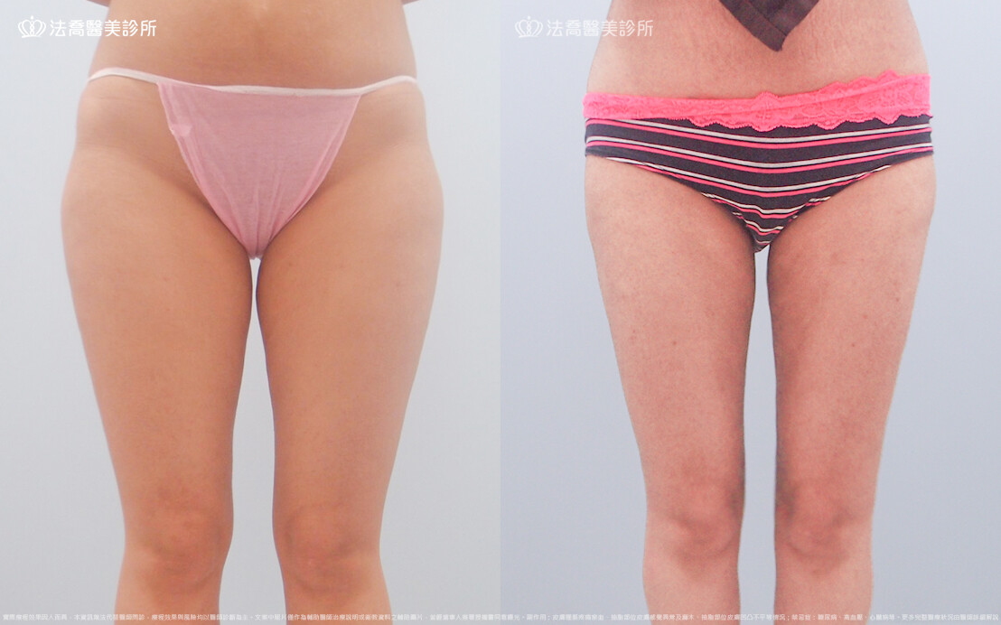 法喬醫美診所,邱浚彥,威塑大腿環抽