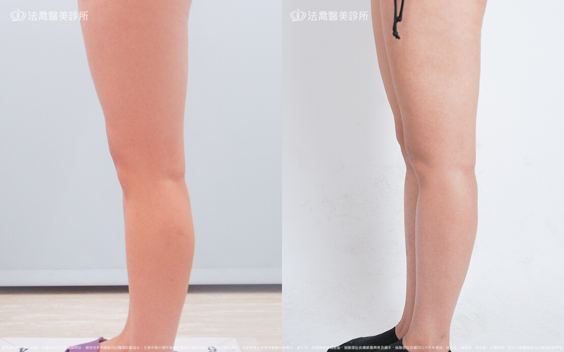 法喬醫美診所,邱浚彥,威塑大腿環抽