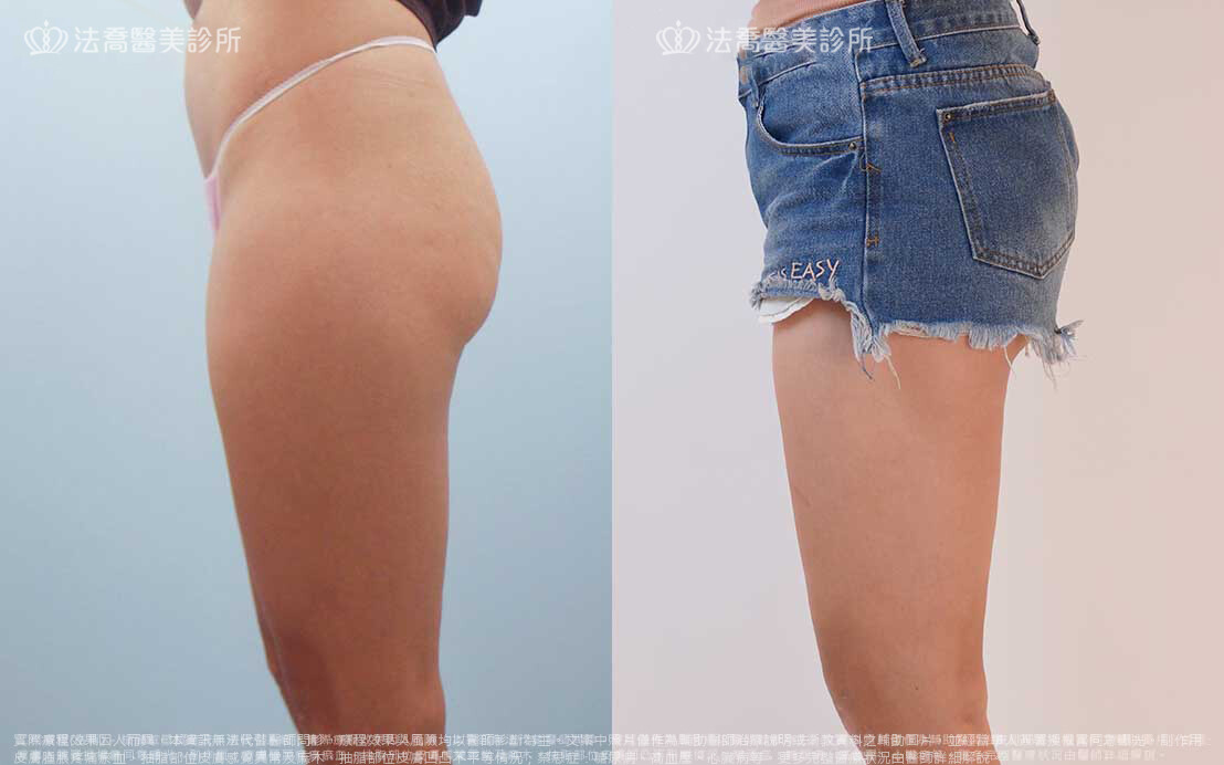 法喬醫美診所,邱浚彥,威塑抽脂