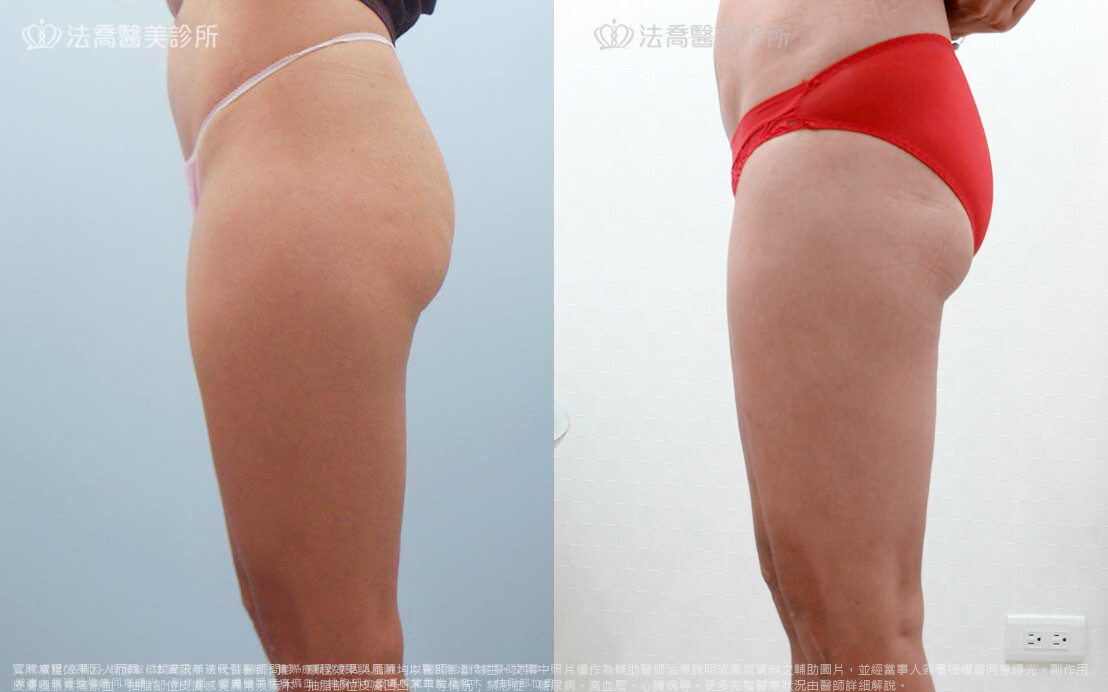 法喬醫美診所,邱浚彥,威塑抽脂