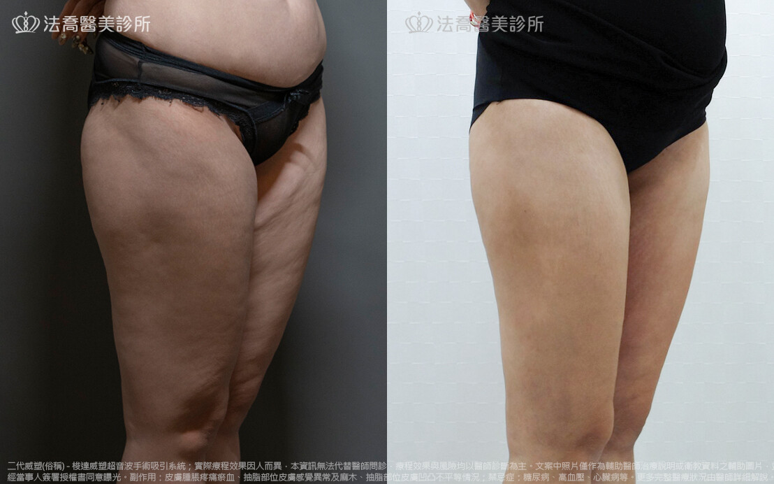 法喬醫美診所,邱浚彥,威塑抽脂