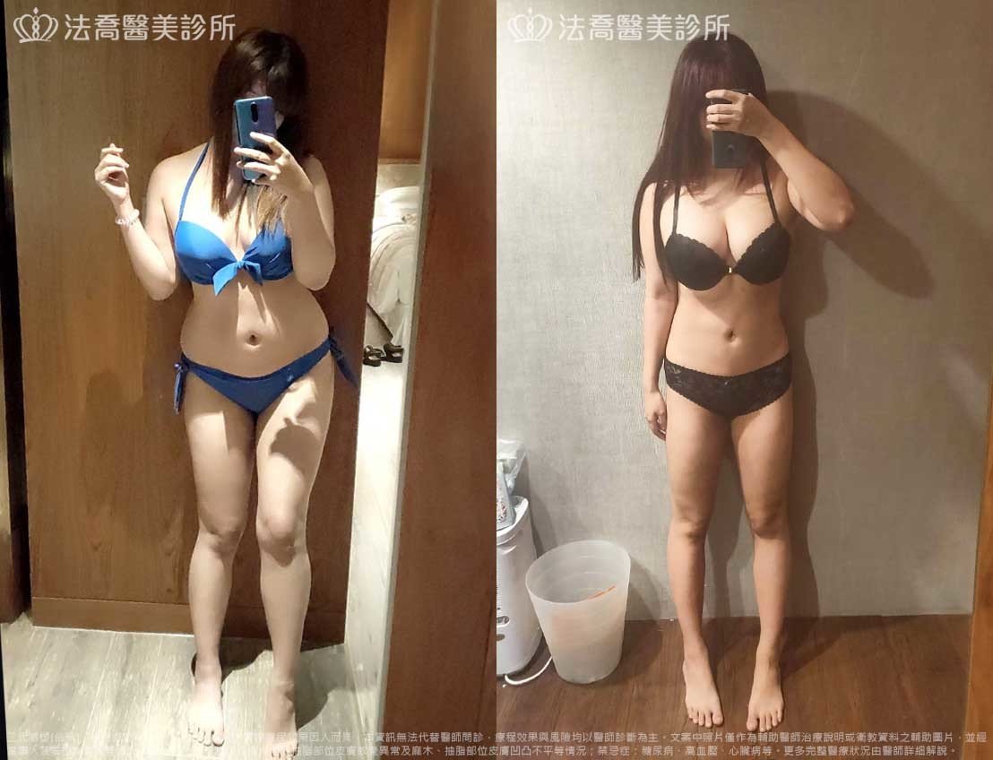 法喬醫美診所,邱浚彥,威塑抽脂