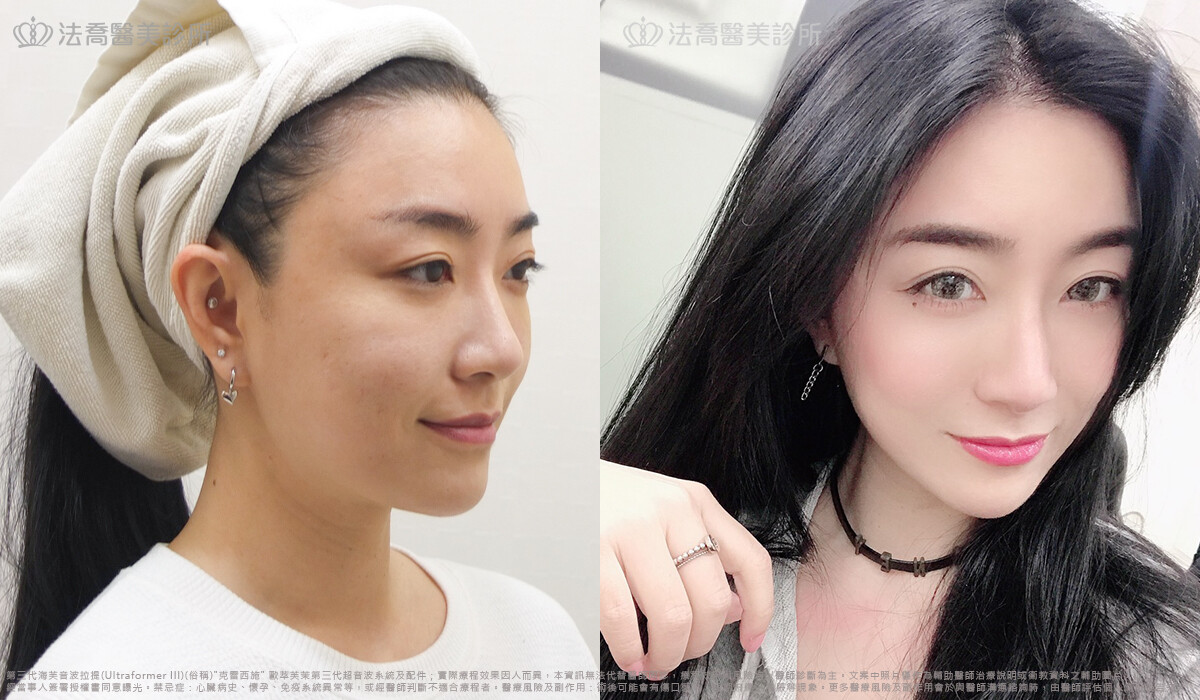 法喬醫美診所,許文碩醫師,海芙音波