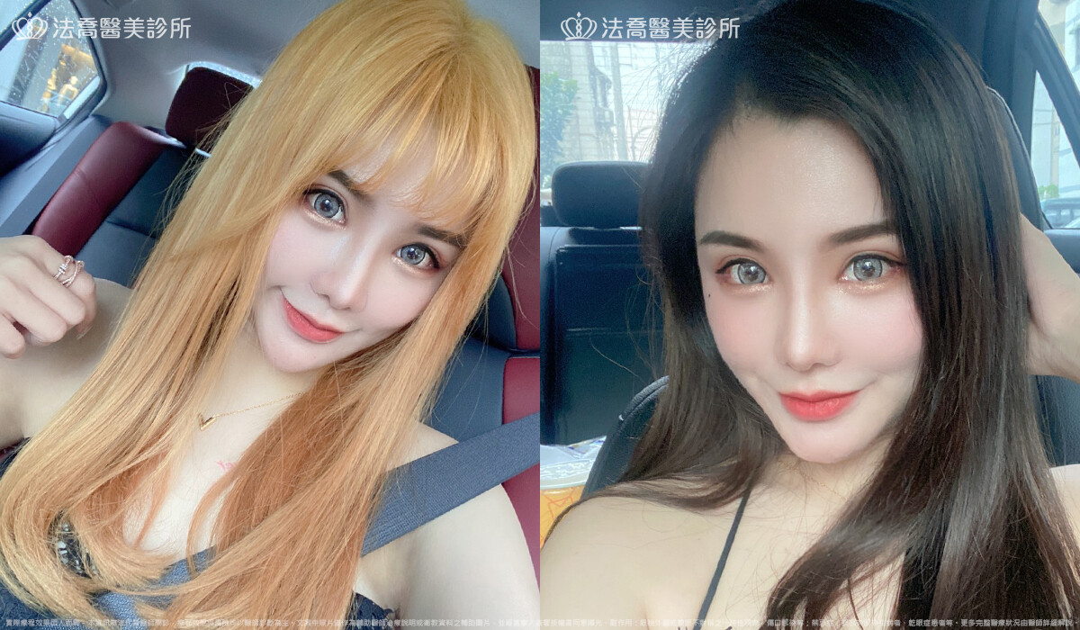 開眼頭、開眼尾、眼尾下置術