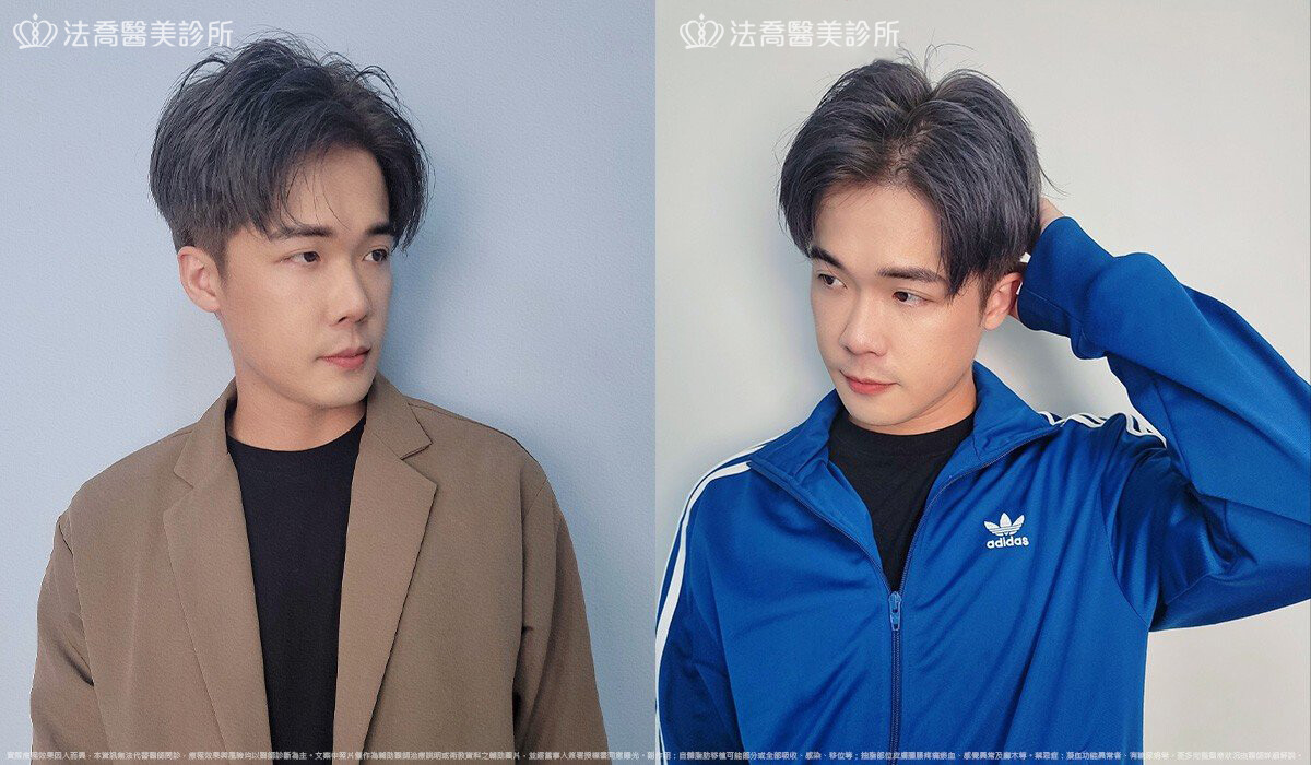 眼袋內開、脂肪移位 / 術後3個月