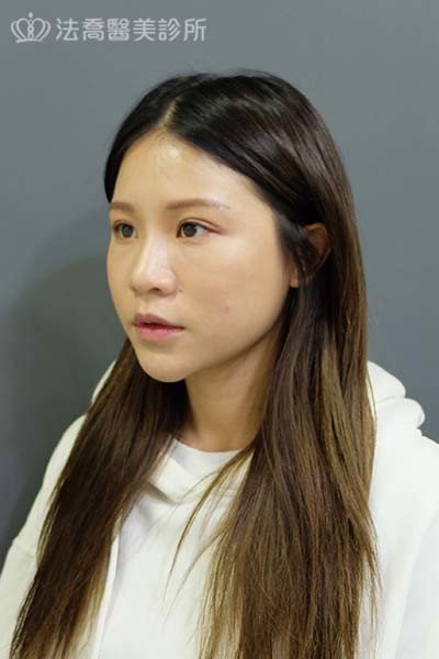 法喬醫美診所 邱浚彥醫師 自體肋骨隆鼻