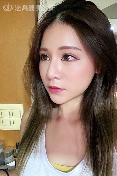 法喬醫美診所 邱浚彥醫師 自體肋骨隆鼻