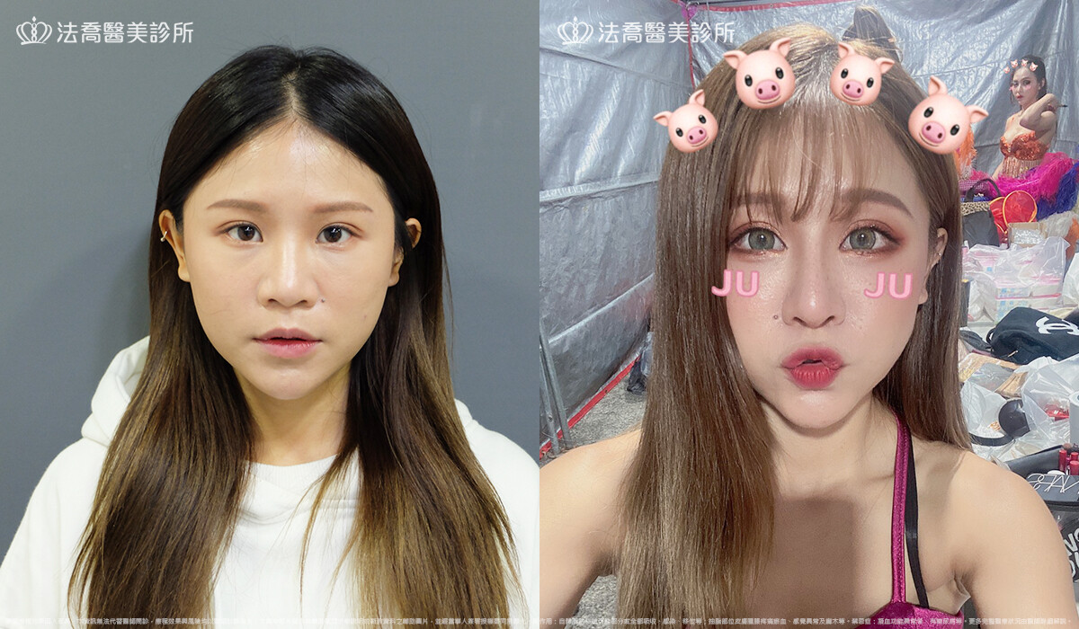 法喬醫美診所,邱浚彥,自體肋骨隆鼻